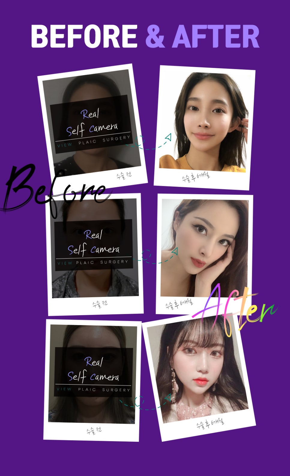 얼굴형의 밸런스를 맞춰주는 안면윤곽수술 관련 이미지 14