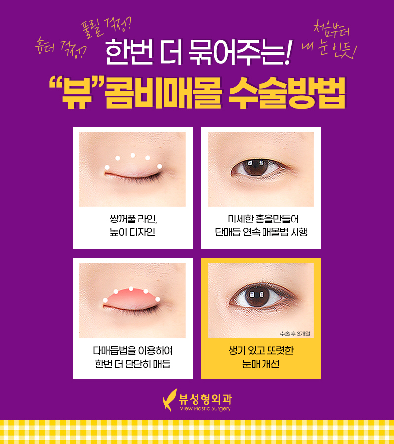 쌍꺼풀수술비용, 목적에 맞춰서 관련 이미지 4