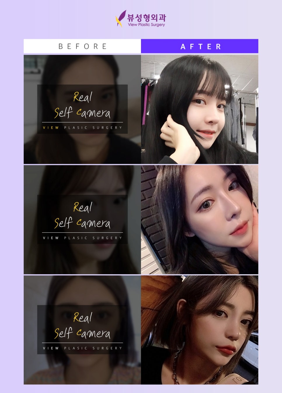 얼굴의 비율과 균형, 조화를 이루는 코성형 관련 이미지 5