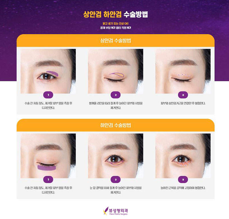 내게 맞는 눈성형을 위한 수술방법 관련 이미지 14