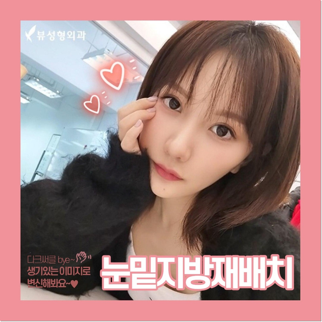 눈밑지방재배치로 인상이 확 달라졌어요.&hearts; 관련 이미지 1