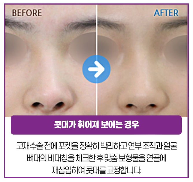 완성도 높은 코를 위한 체계적인 플랜, 코재수술 관련 이미지 5