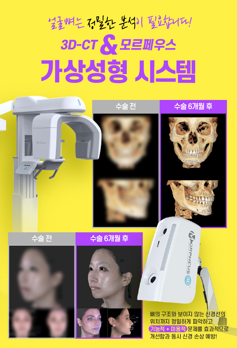 광대뼈축소, 부작용은 줄이고 만족도는 높이려면? 관련 이미지 4