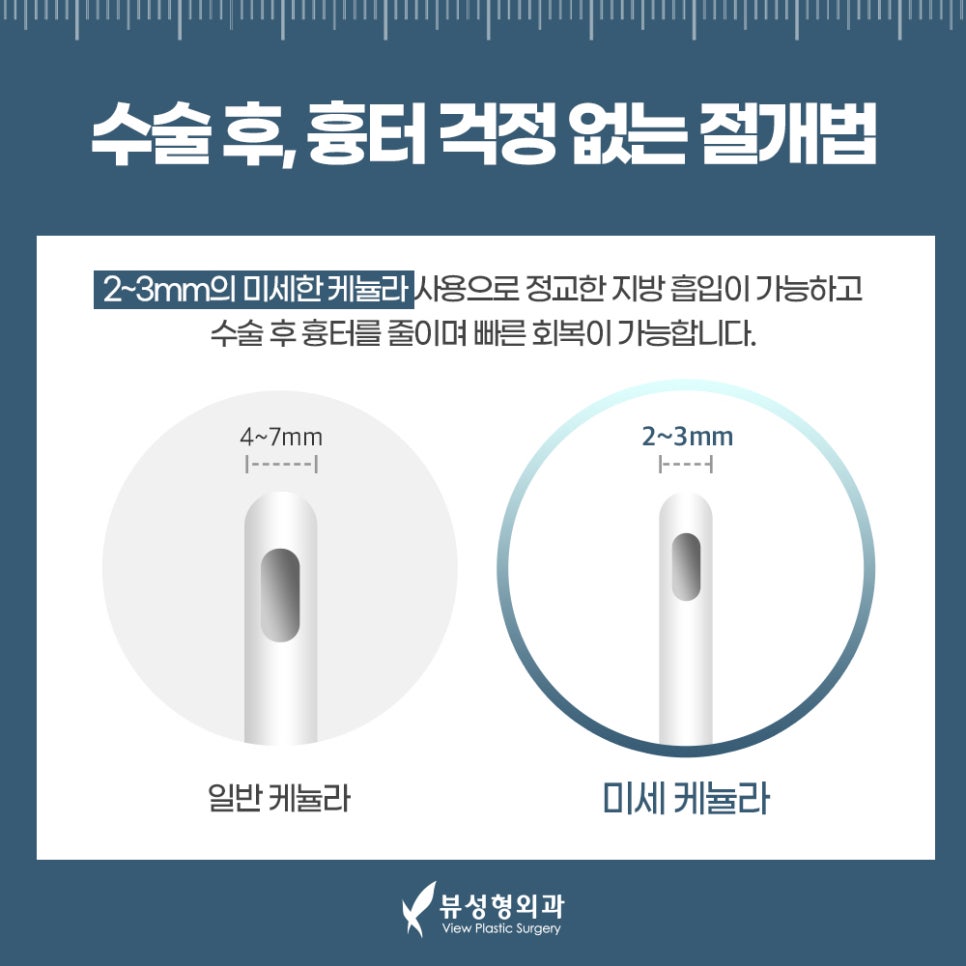 지방흡입, 체중감량술이 아닌 체형교정술 관련 이미지 14