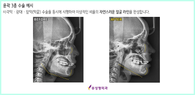 작고 부드러운 V라인? VIEW 페이스오프 관련 이미지 3