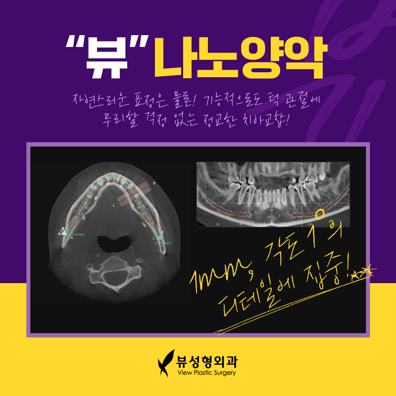 예뻐지는 수술? 양악수술의 올바른 정보 관련 이미지 4