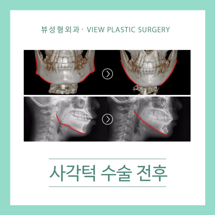 안면윤곽성형 황금비율 찾는 사각턱성형이 필요해 관련 이미지 3