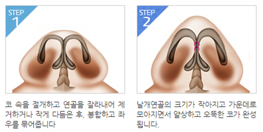 얼굴의 비율과 균형, 조화를 이루는 코성형 관련 이미지 7