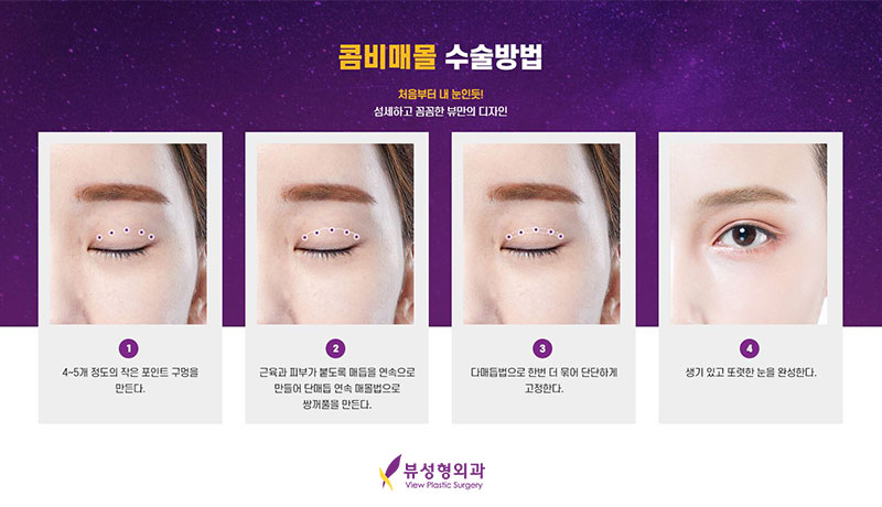 내게 맞는 눈성형을 위한 수술방법 관련 이미지 3