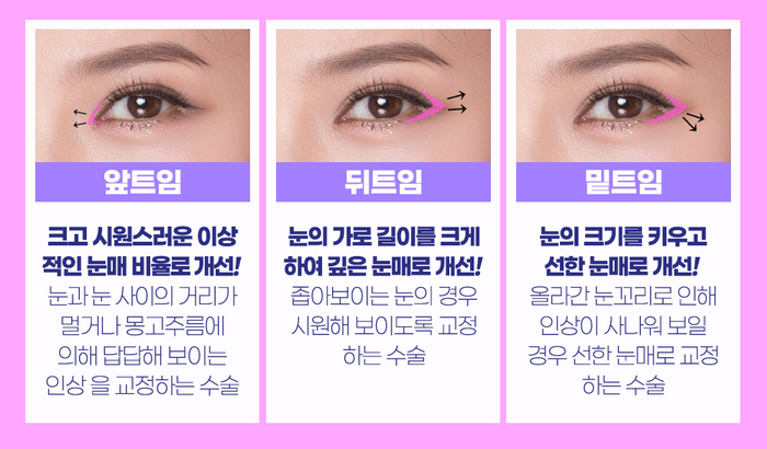 나만의 눈성형을 위한 수술방법 알아보기 관련 이미지 8