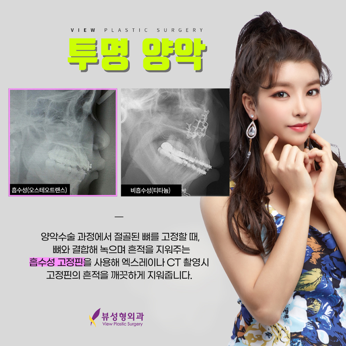 예뻐지는 수술? 양악수술의 올바른 정보 관련 이미지 8