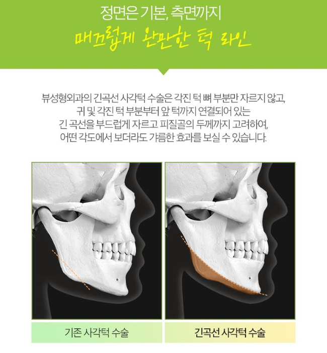 사각턱수술잘하는곳 뷰성형외과 긴곡선사각턱수술로 변화된 모습 관련 이미지 5