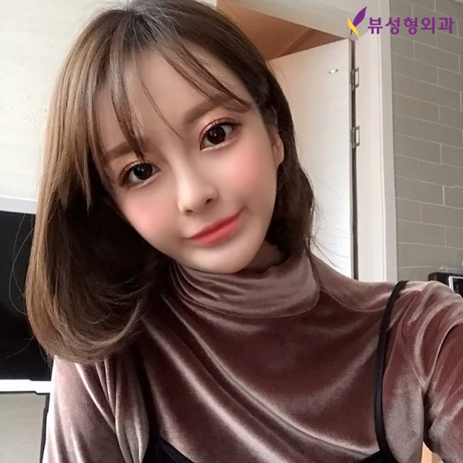 뷰성형외과 눈성형으로 예쁨 가득&hearts; 관련 이미지 3