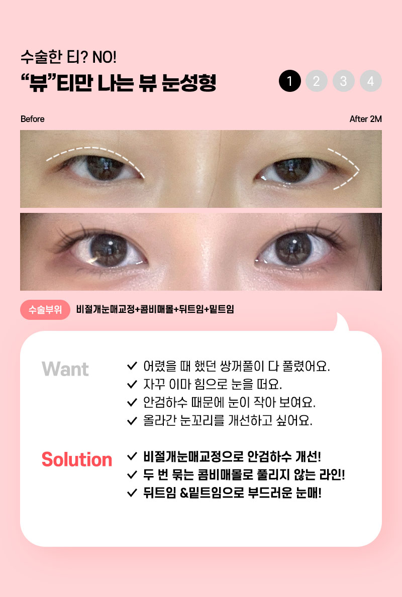 쌍꺼풀수술 잘하는 곳을 찾고 있다면 관련 이미지 6