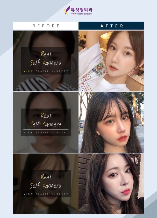 작고 이상적인 얼굴형을 위한 안면윤곽수술 관련 이미지 8