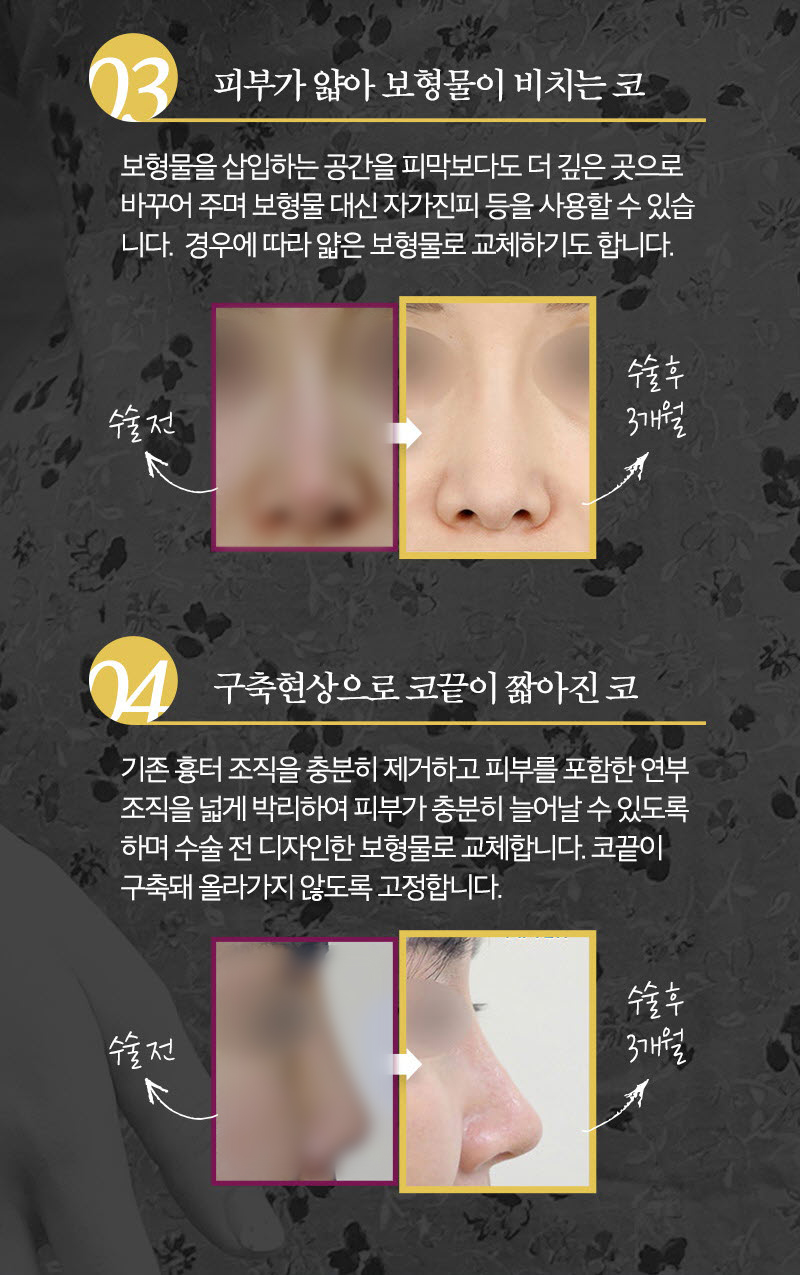 코재수술후기 꼼꼼하게 따져 보아야 할 점은 관련 이미지 5