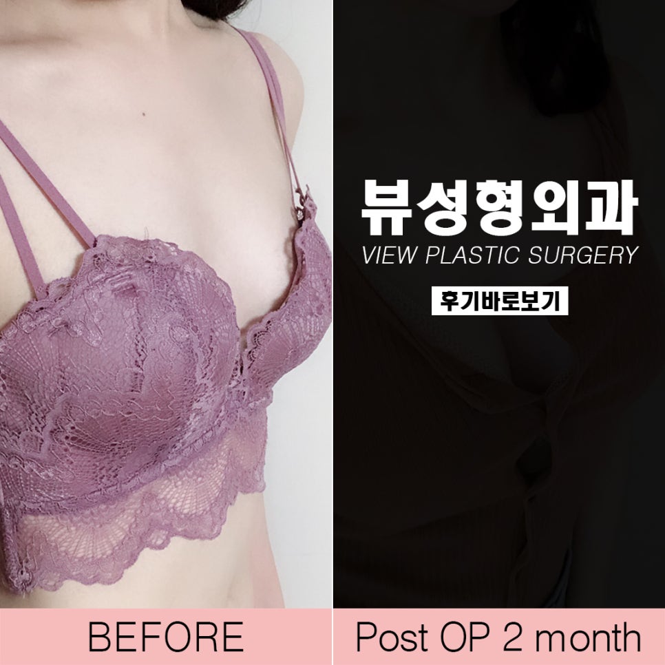 가슴성형후기 뷰성형외과 확실히 보여드릴께요 관련 이미지 5