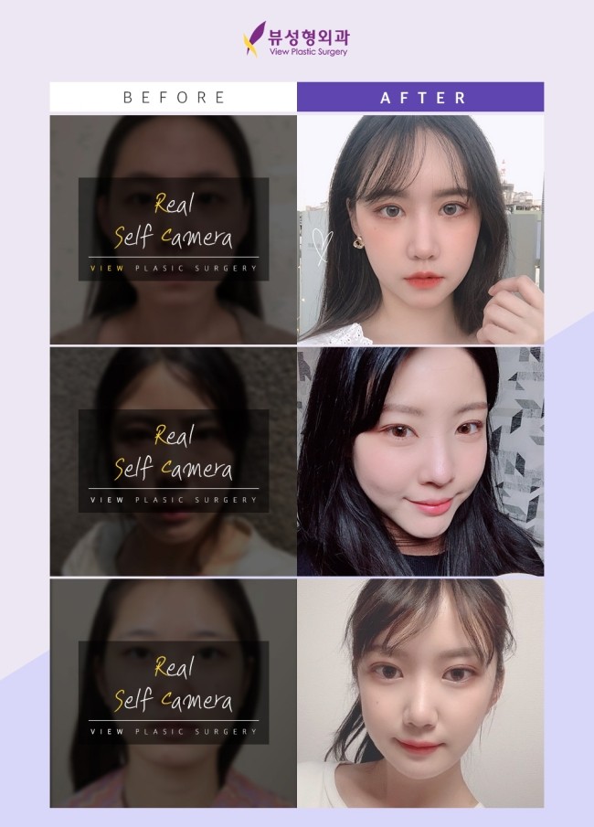 내 눈에 맞는 눈성형, 유형별 총 정리 관련 이미지 7