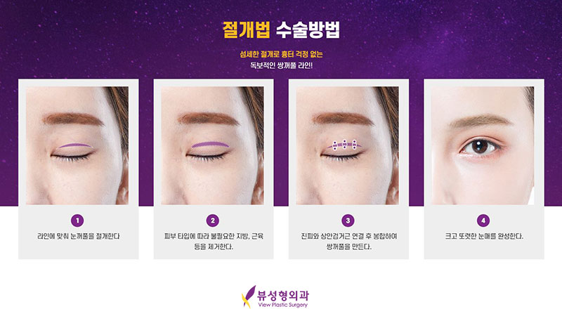 내게 맞는 눈성형을 위한 수술방법 관련 이미지 4