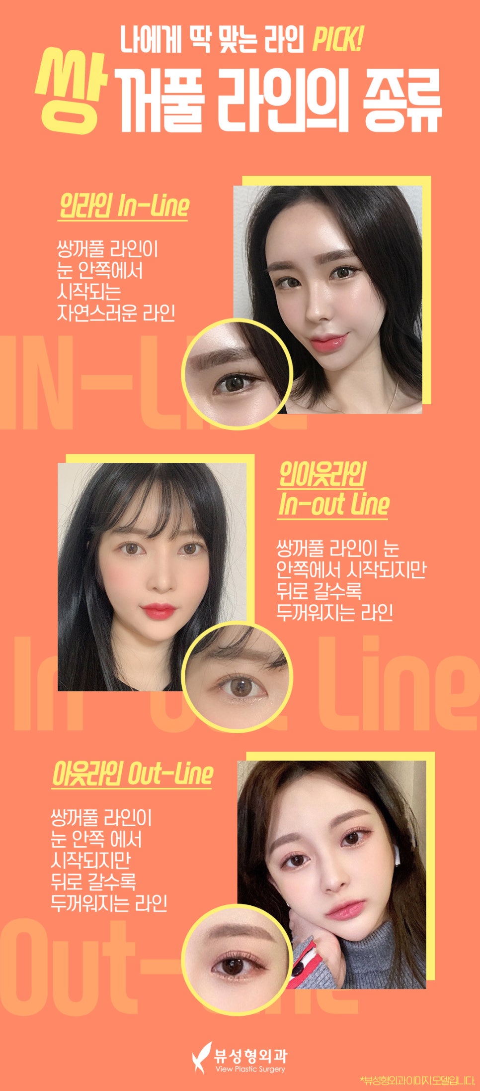 쌍꺼풀매몰법, 뷰에서 빠른 회복까지! 관련 이미지 2