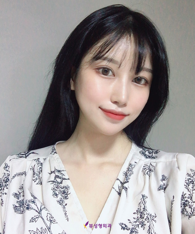 무턱때문에 고민이라면 VIEW로! 관련 이미지 5