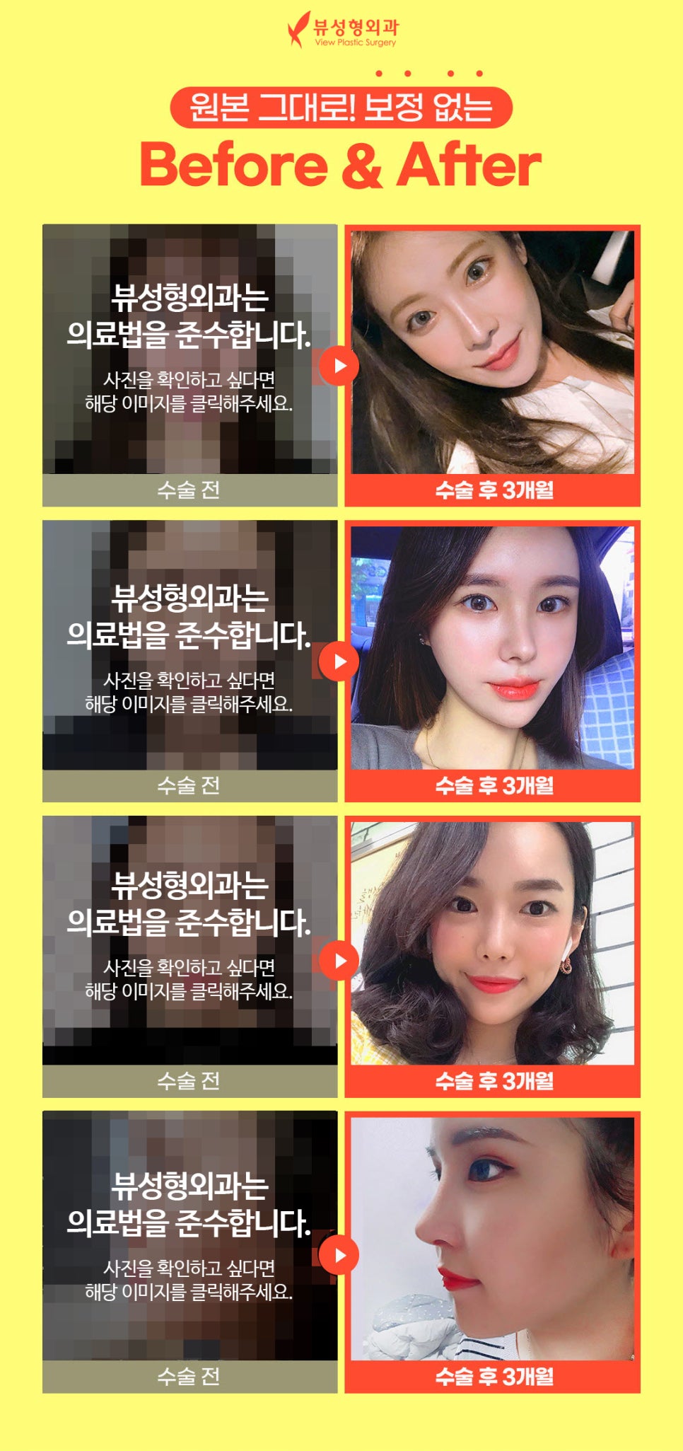 코수술비용 예산은 얼마나 잡아야 할까? 관련 이미지 2