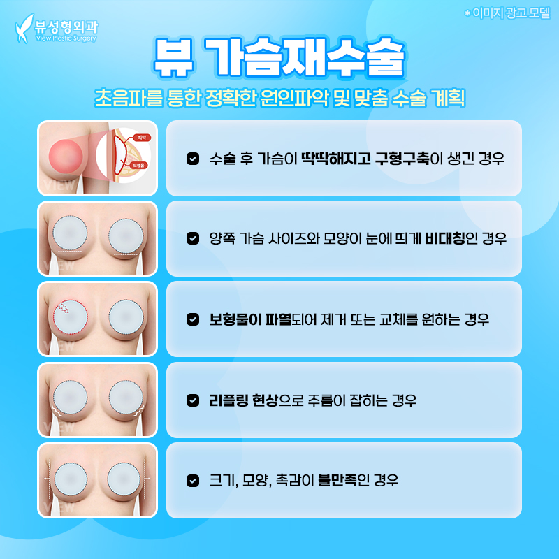 가슴 재수술, 꼭 알아야 하는 피막☝🏻 관련 이미지 1