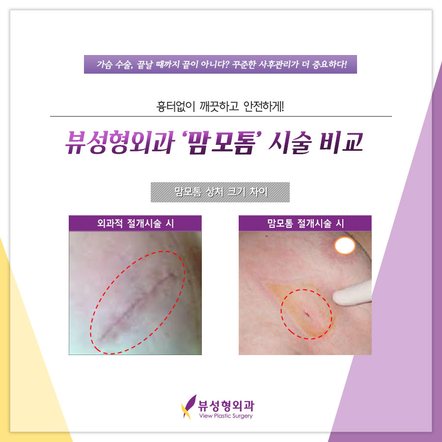 유방검진 맘모톰시술의 중요성! 관련 이미지 3