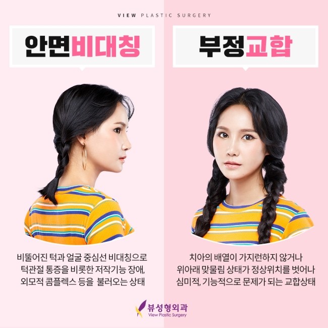 예뻐지는 수술? 양악수술의 올바른 정보 관련 이미지 3