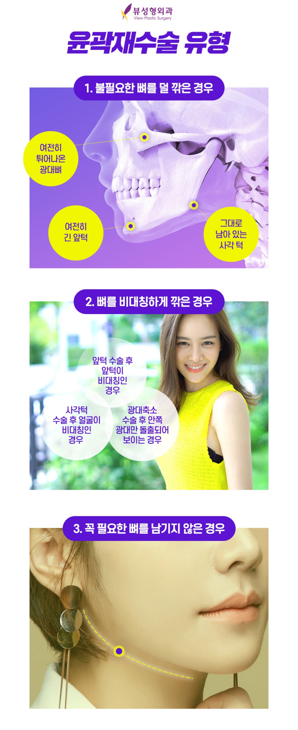 안면윤곽재수술 후기 | 발품 꿀팁 관련 이미지 3