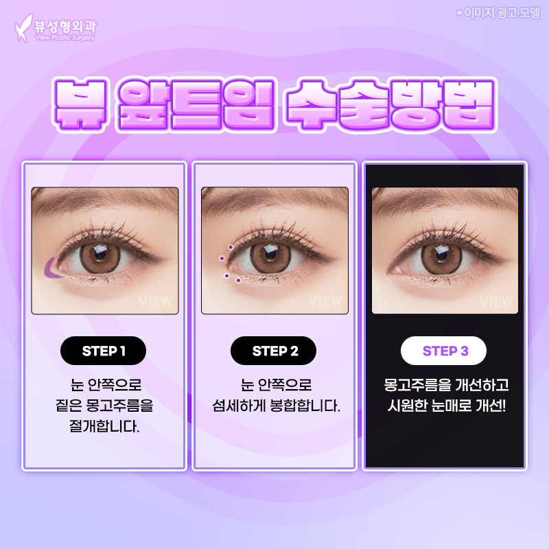 내게 맞는 눈성형 알아보기 관련 이미지 10