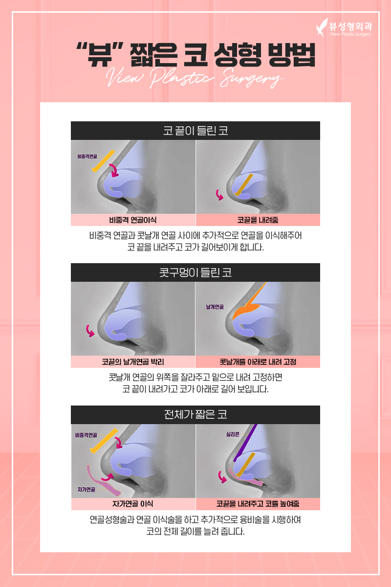 짧은코성형, 뷰에서 뷰티풀하게 관련 이미지 3