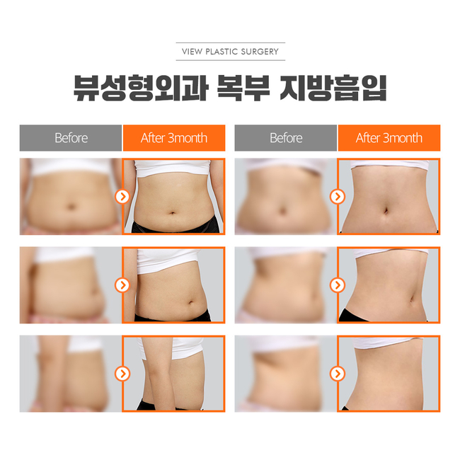 원하는 부위만 쏙쏙 지방흡입으로 지방뿌시기! 관련 이미지 7
