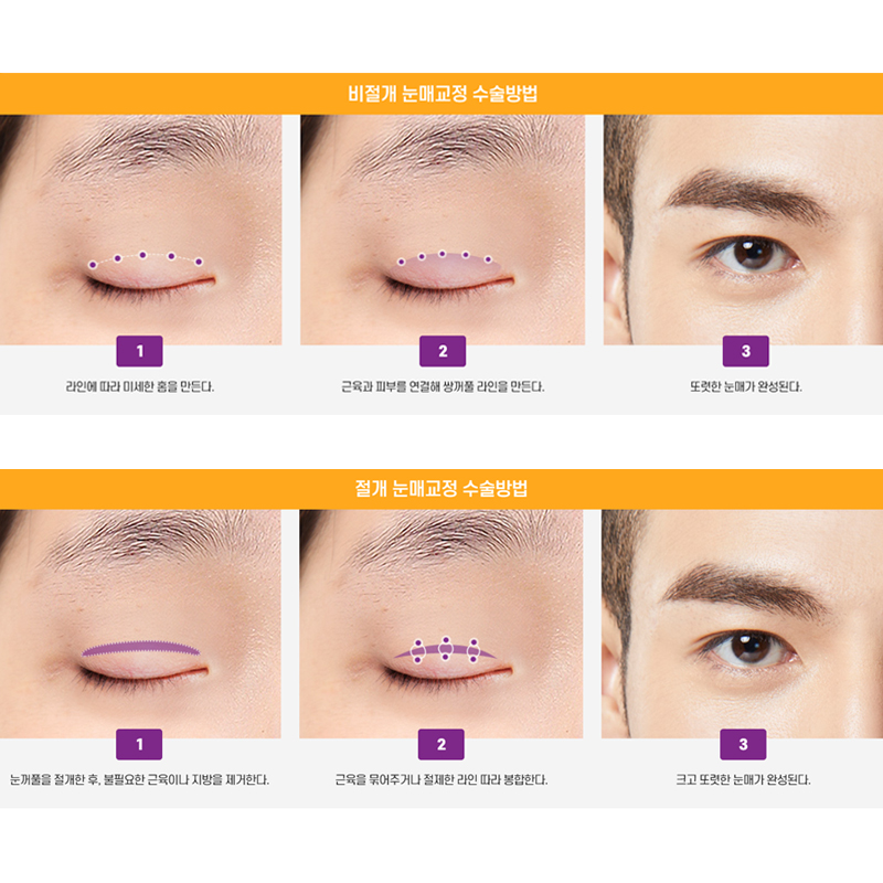 남자눈매교정 개인 상황에 맞춰 뷰에서 관련 이미지 5