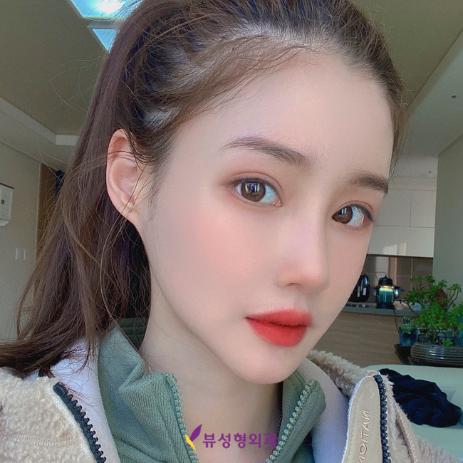 사각턱수술잘하는곳 뷰성형외과 긴곡선사각턱수술로 변화된 모습 관련 이미지 2