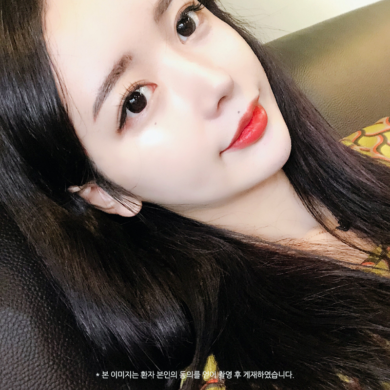 코성형, 개인별 유형에 적합한 수술방법은? 관련 이미지 3