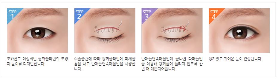 쌍꺼풀수술 나한테 적합한 수술방법은? 관련 이미지 5