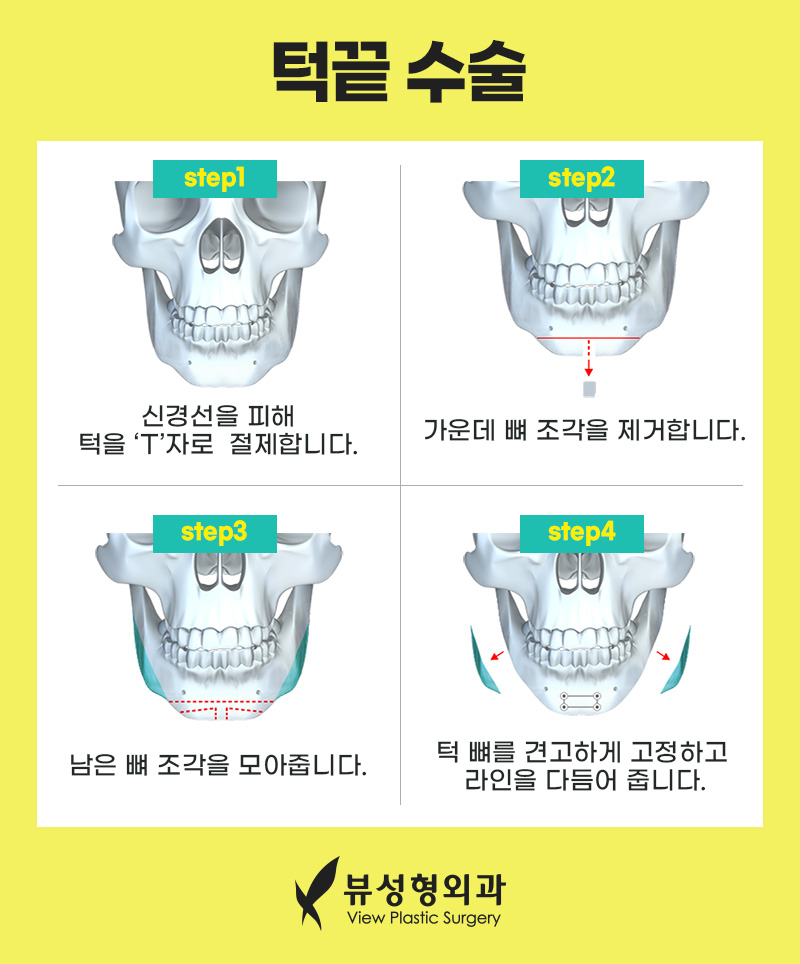 남자안면윤곽수술 개성을 살려서 관련 이미지 9