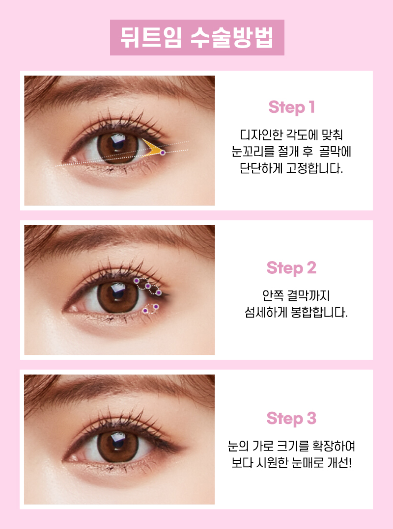 뒤트임, 디귿자 걱정으로 망설여진다면 관련 이미지 4