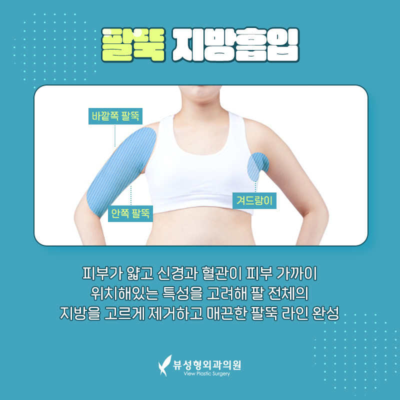 뷰성형외과에서 팔뚝지방흡입하고 직각어깨 됐어요! 관련 이미지 3