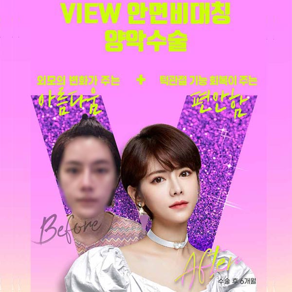 안면비대칭교정방법 자세히 알고 싶다면 관련 이미지 2