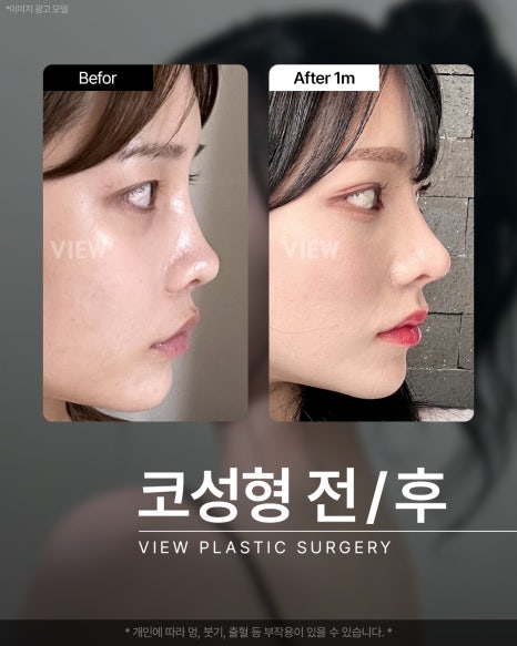 코필러를 앞둔 그대들의 착각...걱정되시는 분만 보세요 관련 이미지 2