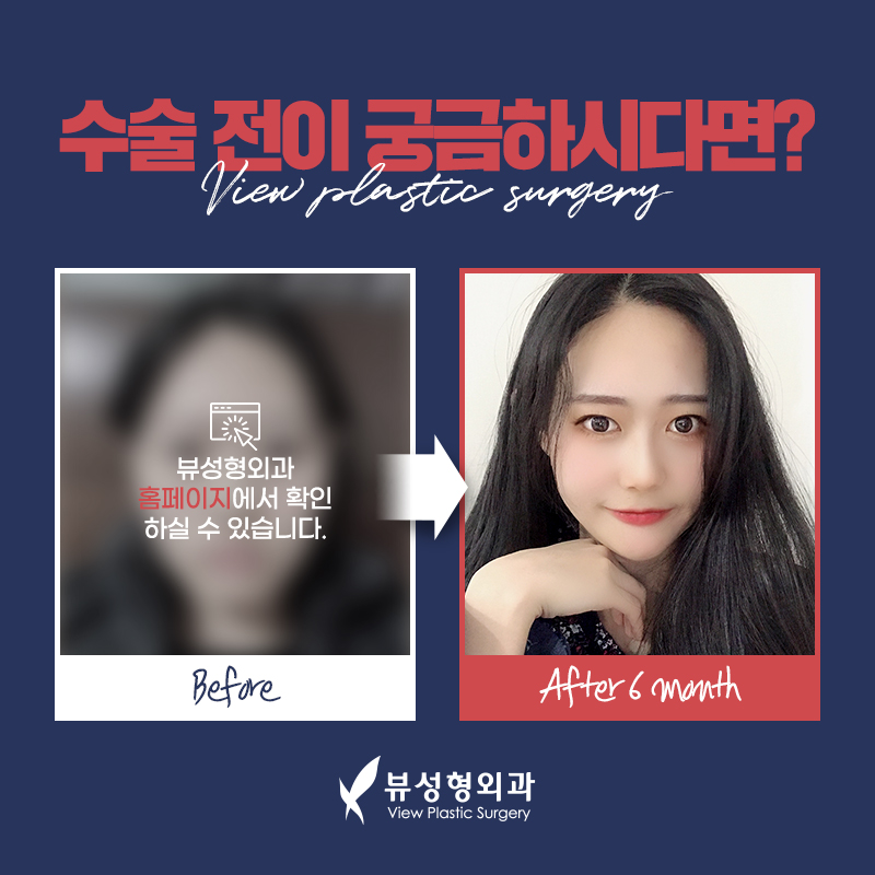 예뻐지는 수술? 양악수술의 올바른 정보 관련 이미지 7