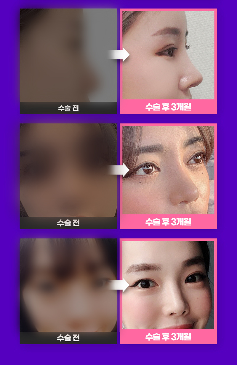 자연스러운코성형 만족도 높은 결과를 위해서는 관련 이미지 5