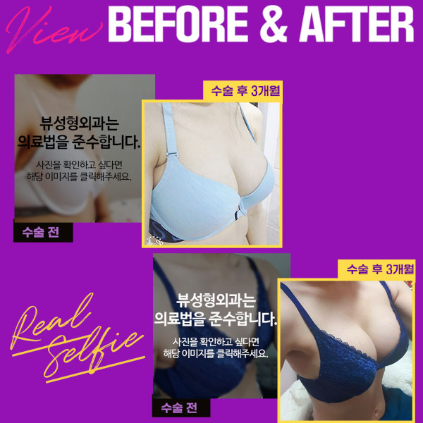 처진가슴수술 종류가 궁금하다면 관련 이미지 3