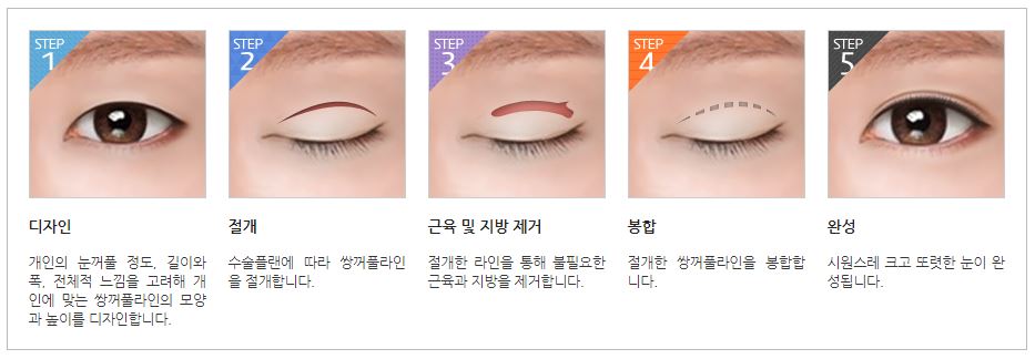 쌍꺼풀수술 나한테 적합한 수술방법은? 관련 이미지 7