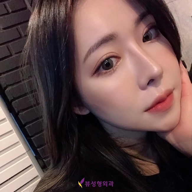 코성형비용 알아봐야 할 부분은? 관련 이미지 2