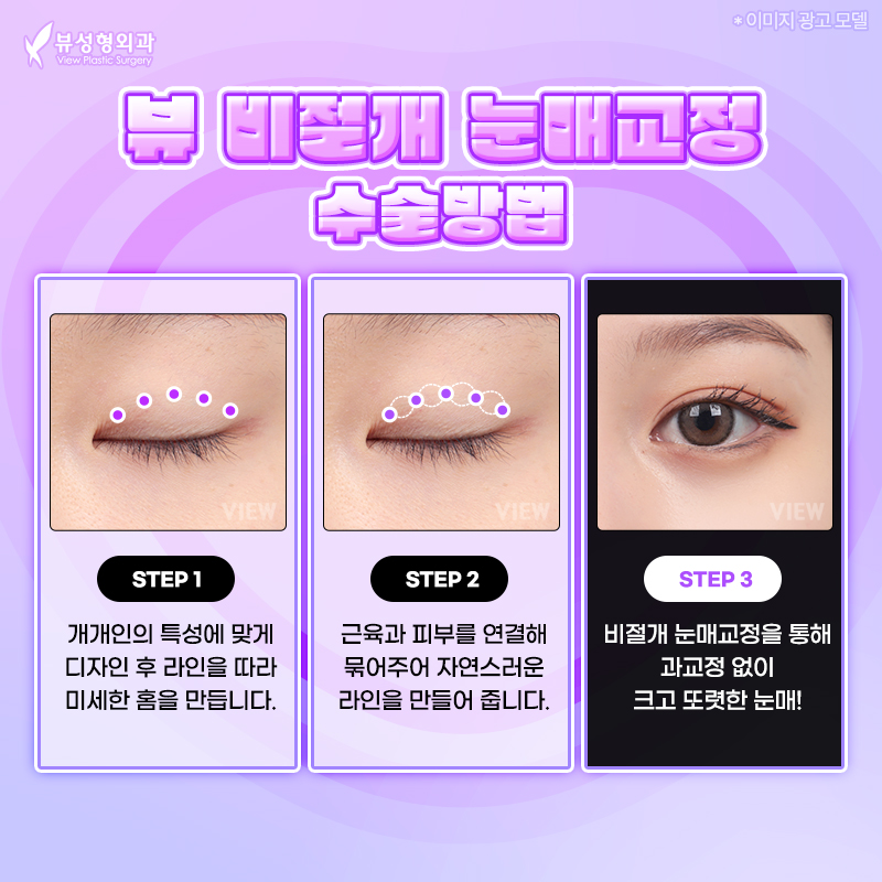 내게 맞는 눈성형 알아보기 관련 이미지 15