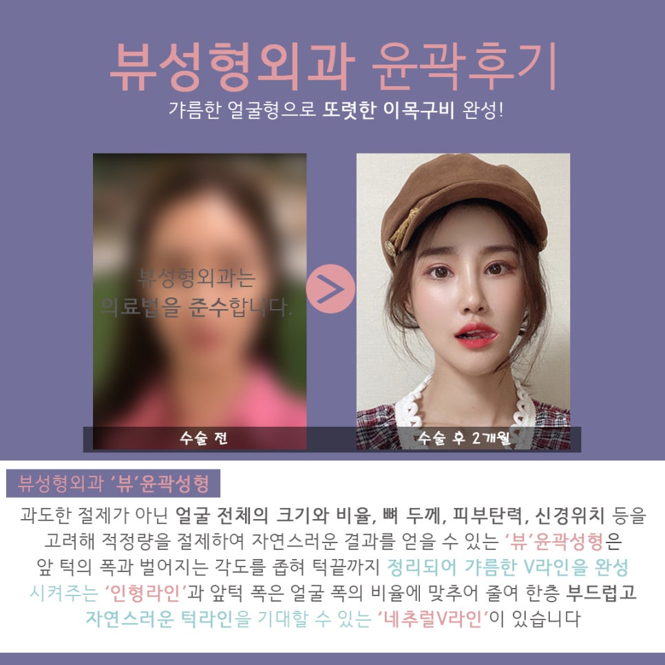 안면윤곽가격 보다 중요한 것은 안전 l 뷰성형외과 관련 이미지 1
