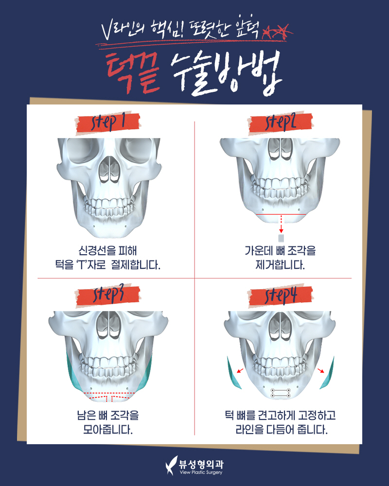 얼굴형의 밸런스를 맞춰주는 안면윤곽수술 관련 이미지 9